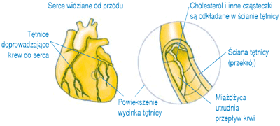 <b>Rysunek 3.</b> Serce oraz ttnica ze zmianami miadycowymi